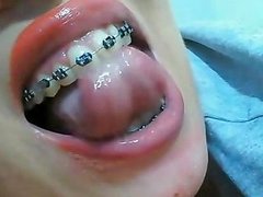 Mouth Fetish Braces Blowjob Hd Porn Video 77 Xhamster